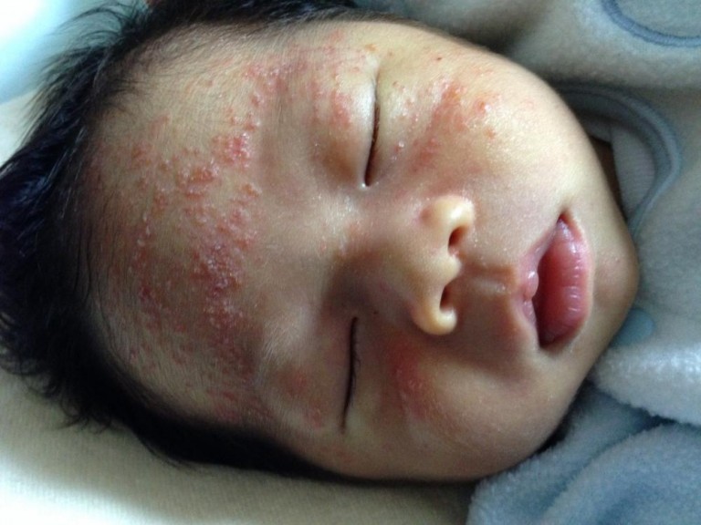 脂漏性湿疹/0~1ヶ月 【赤ちゃんフォト】