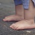 子供に多い尋常性疣贅とは？タコとウオノメとの違い